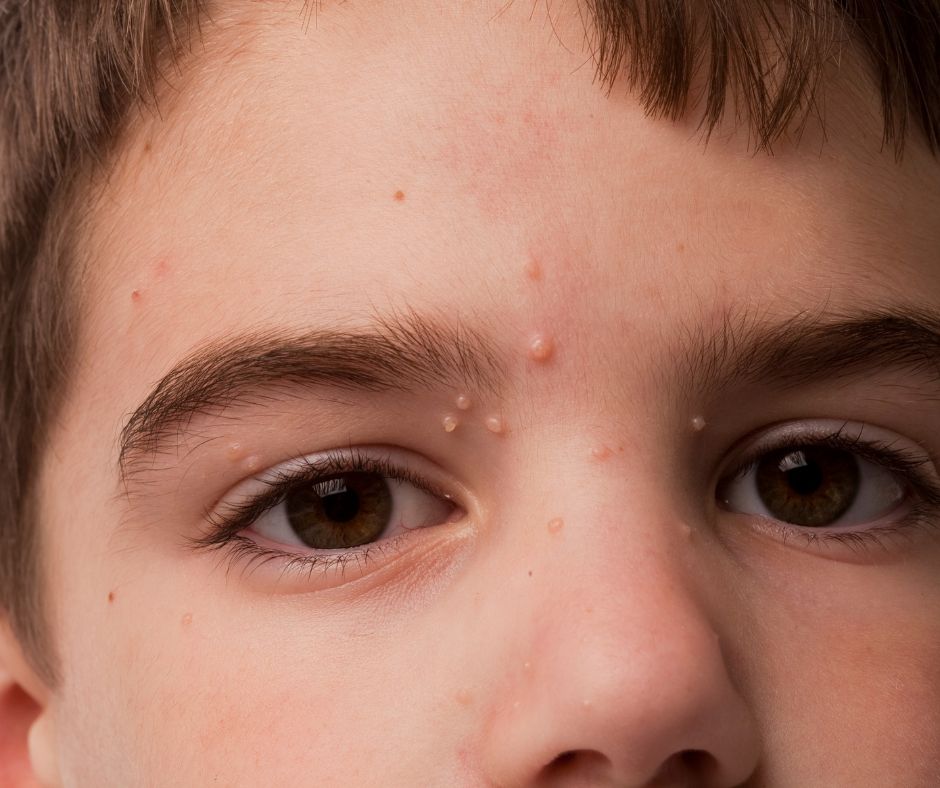 Μολυσματική Τέρμινθος - Δερματολόγος Αφροδισιολόγος Κορυδαλλός | Δήμητρα Τασιούλα Total Derma