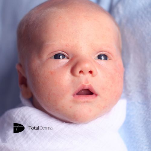 βρεφος ακμη