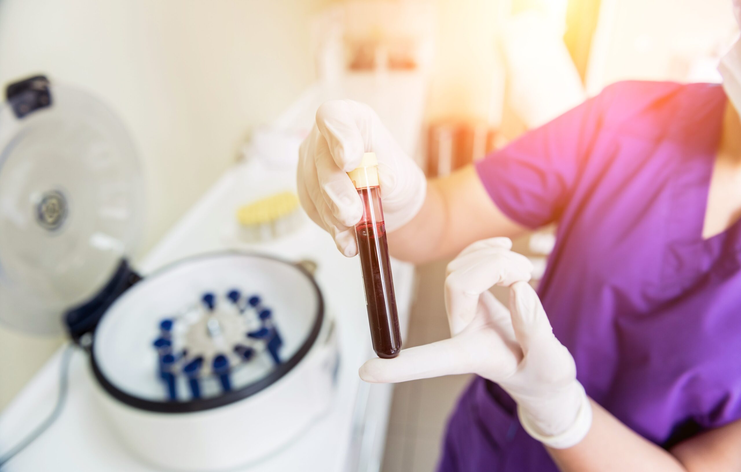 Platelet-Rich plasma preparation. Tube with blood in hands