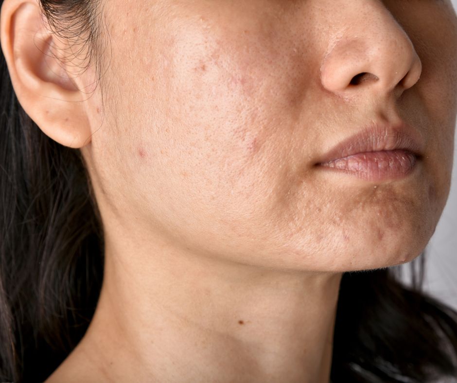 ουλες ακμης