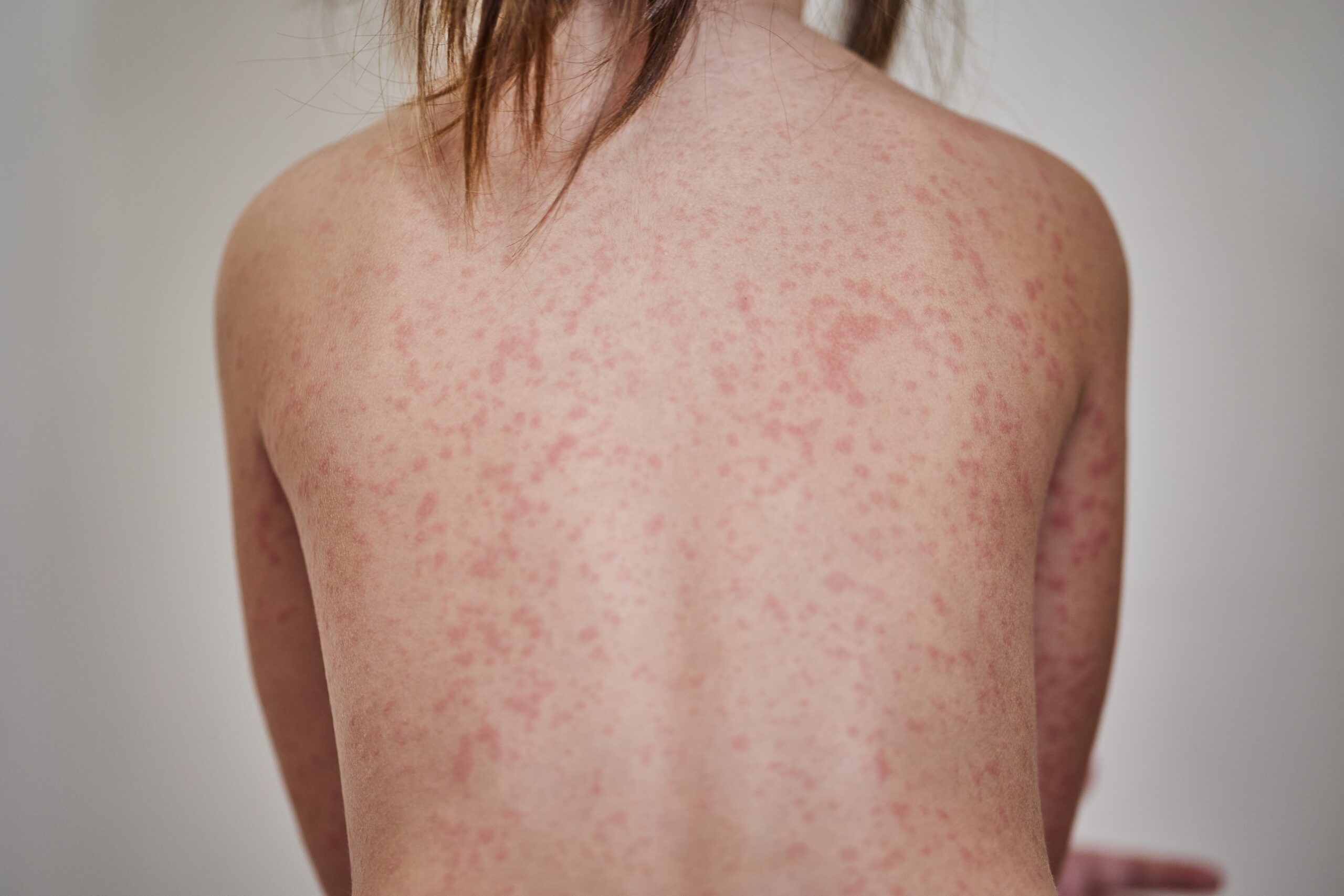 miliaria
